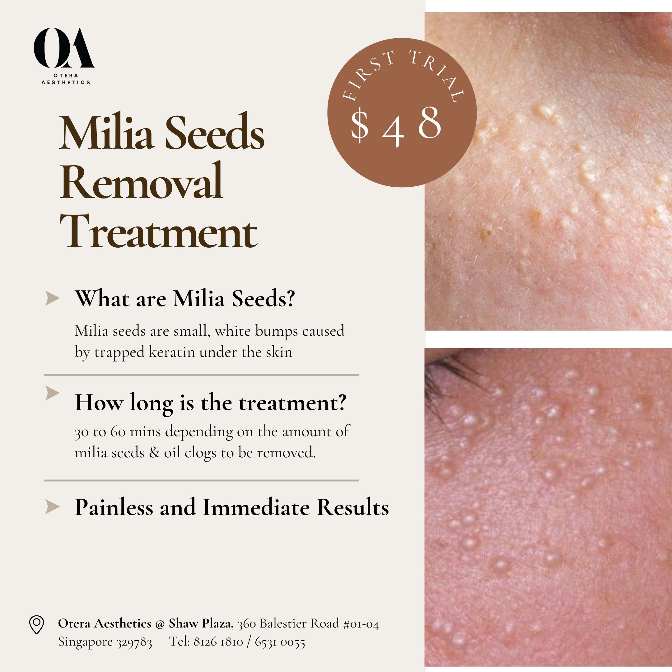 Goodbye Milia @ $48 only!