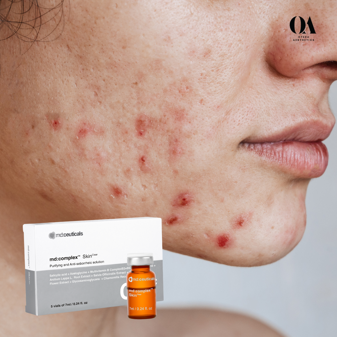 md acne