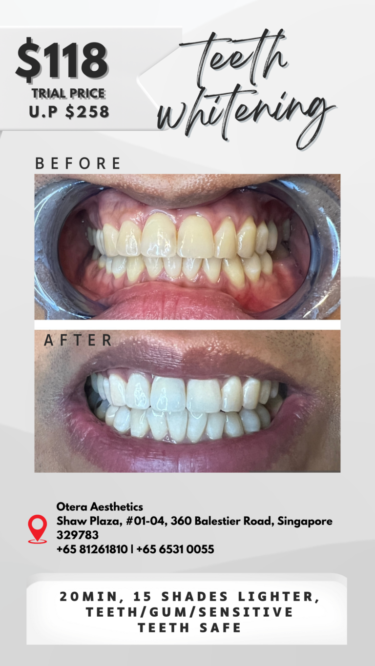 Brighter Smile Teeth Whitening First Trial – $118 (U.P. $258)