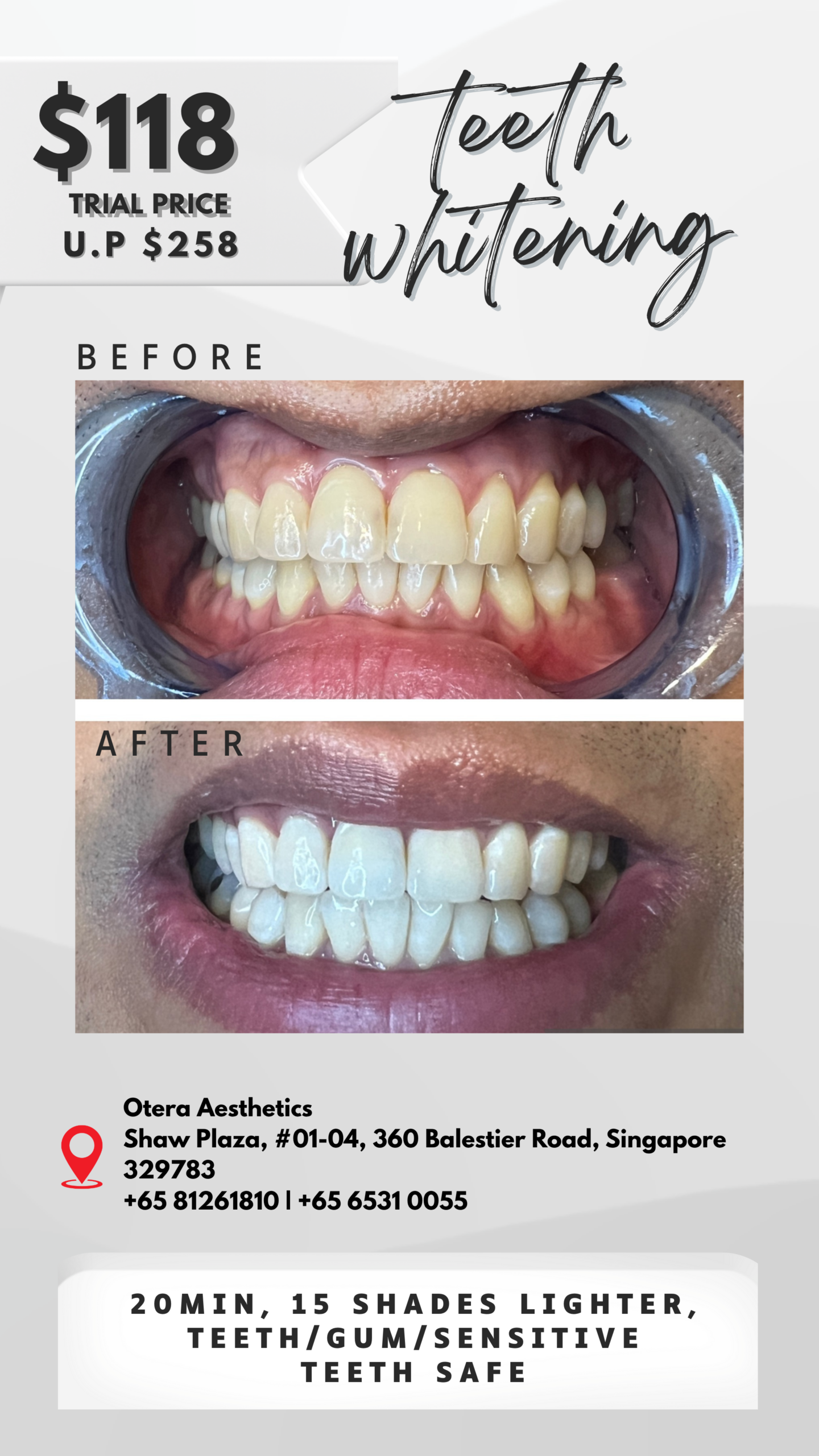 Brighter Smile Teeth Whitening First Trial – $118 (U.P. $258)